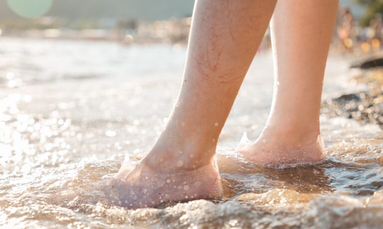 Varizes e o Verão: como cuidar das pernas na estação mais quente